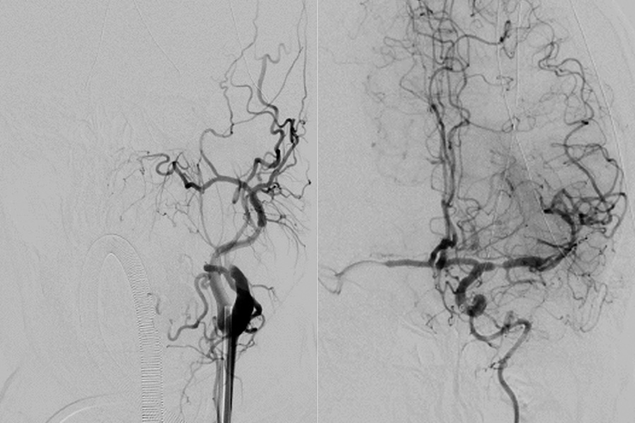 Angiopraphie Bild Vorher Nachher einer Patientin in der Klinik Landstrasse