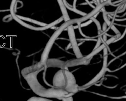 3D Angiographie Bild